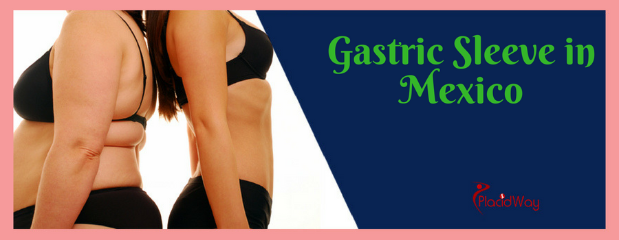 Gastric Sleeve in Mexico